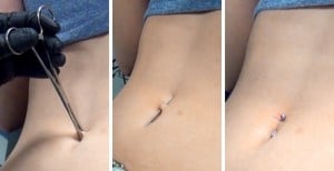 Belly Button Rings procedure