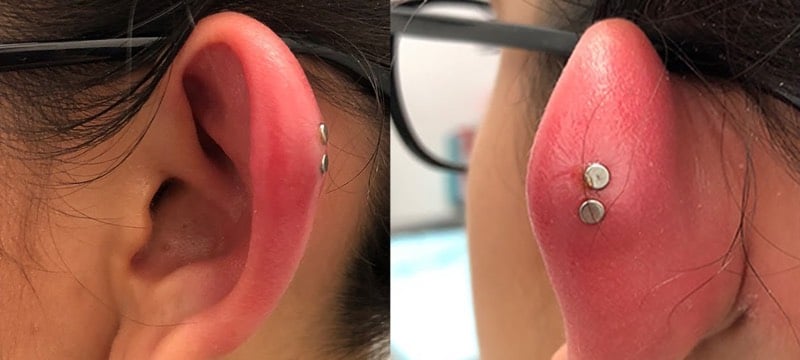 ear piercing infection signs symptoms