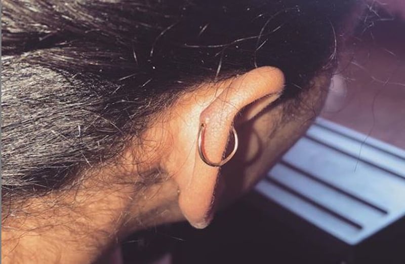 piercing bump back of ear