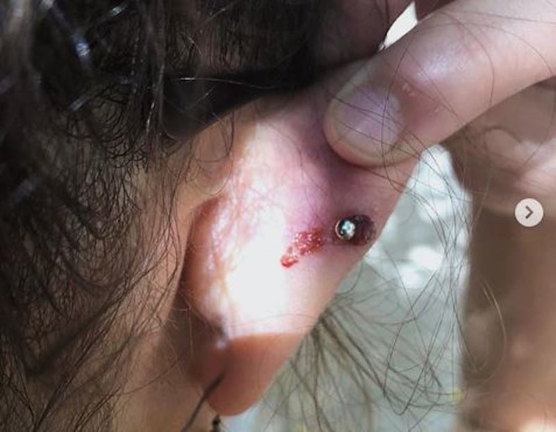 piercing infection ear piercing