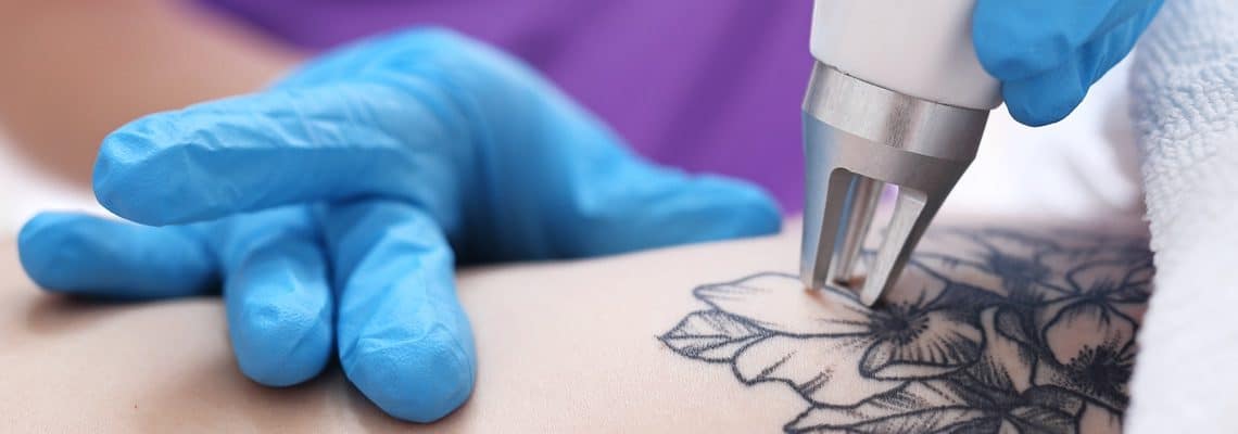 best tattoo removal methods