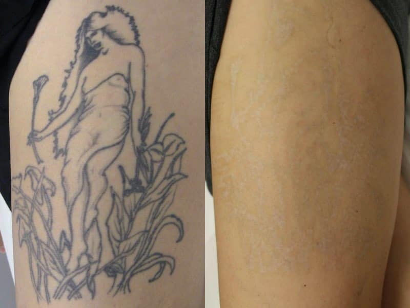 Dermabrasion tattoo removal method